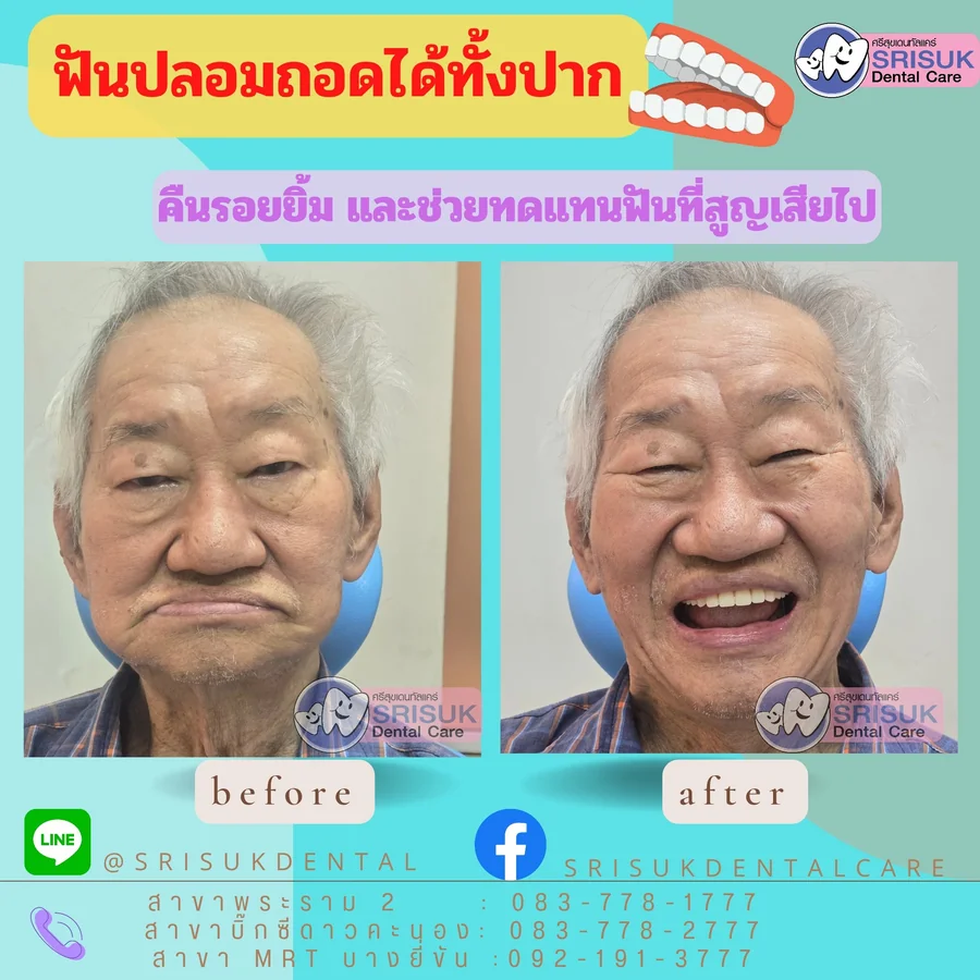 ฟันปลอม 1