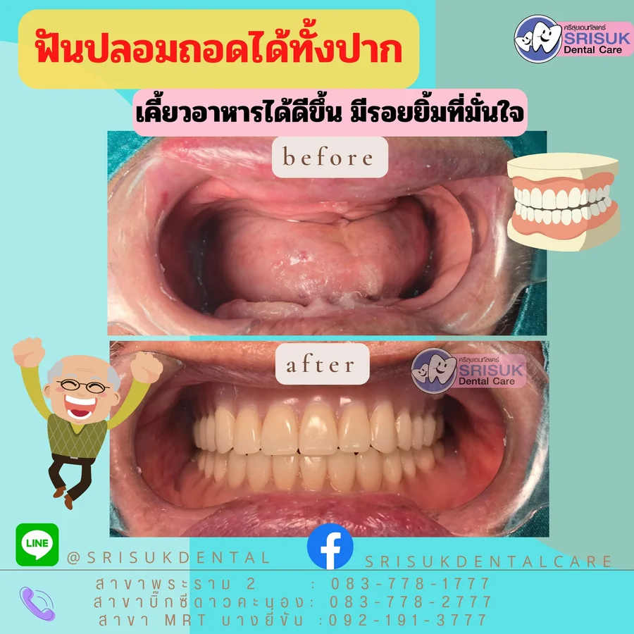 ฟันปลอม 2