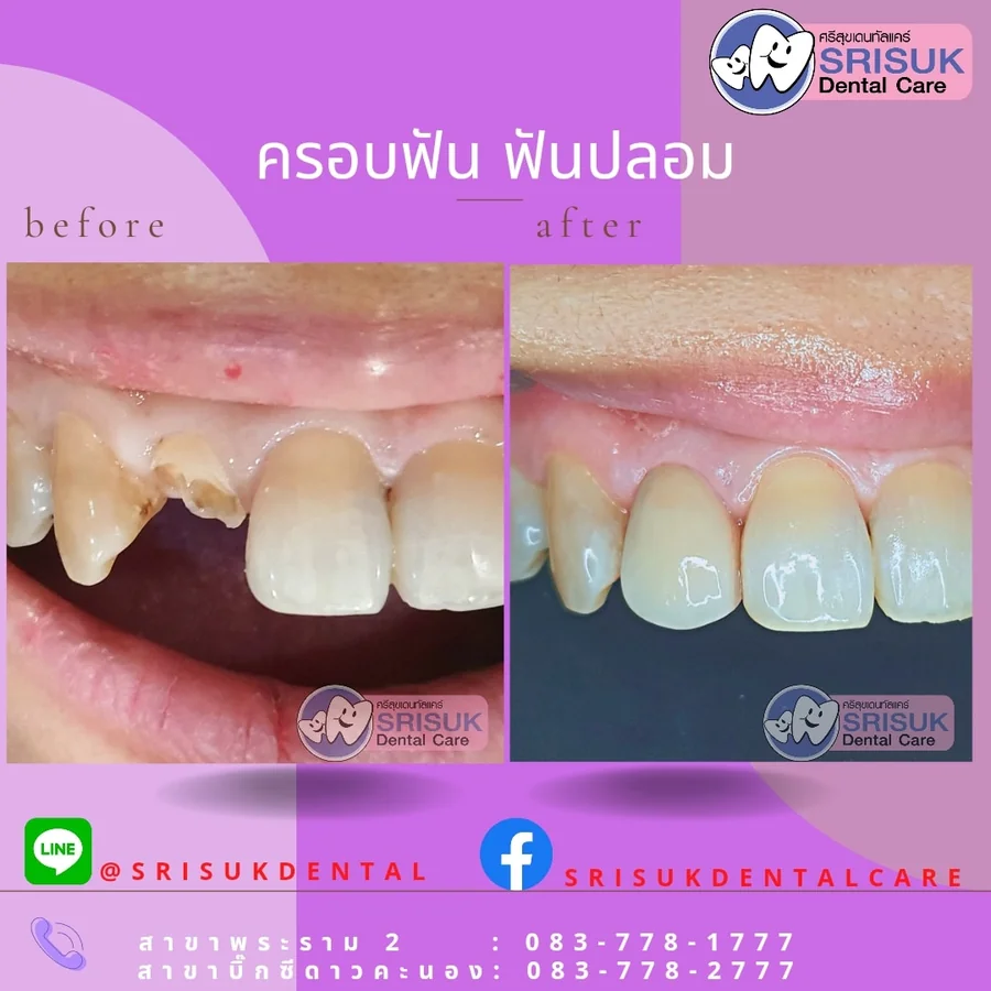 ฟันปลอม 4