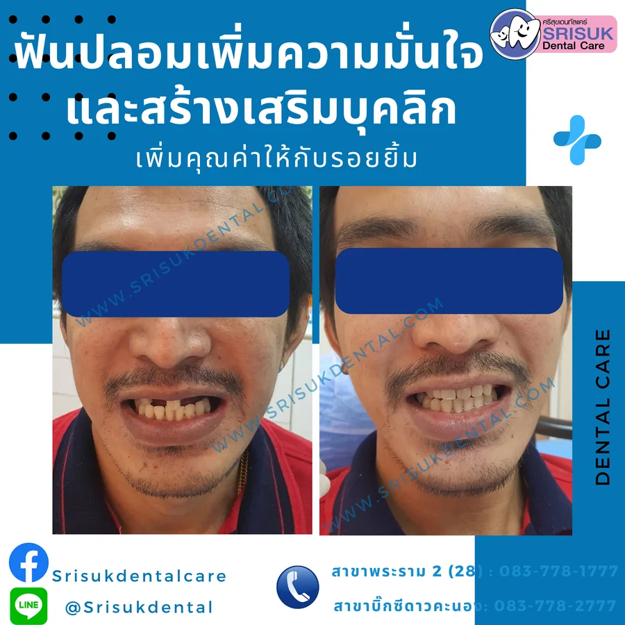 ฟันปลอม 6