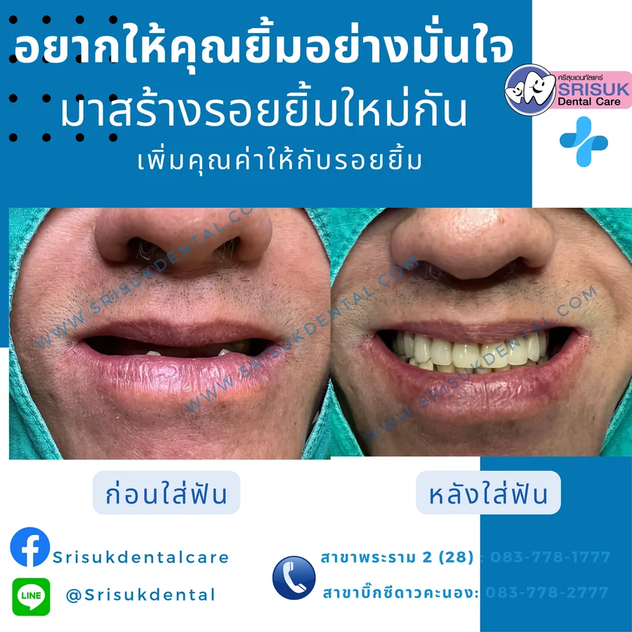 ฟันปลอม 8