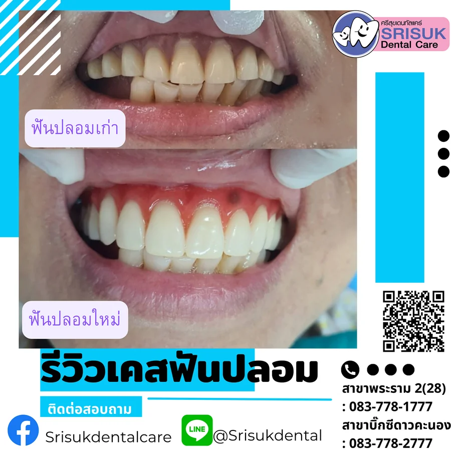 ฟันปลอม 9