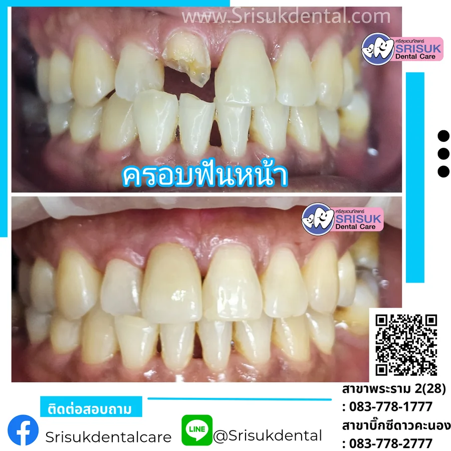 ฟันปลอม 10