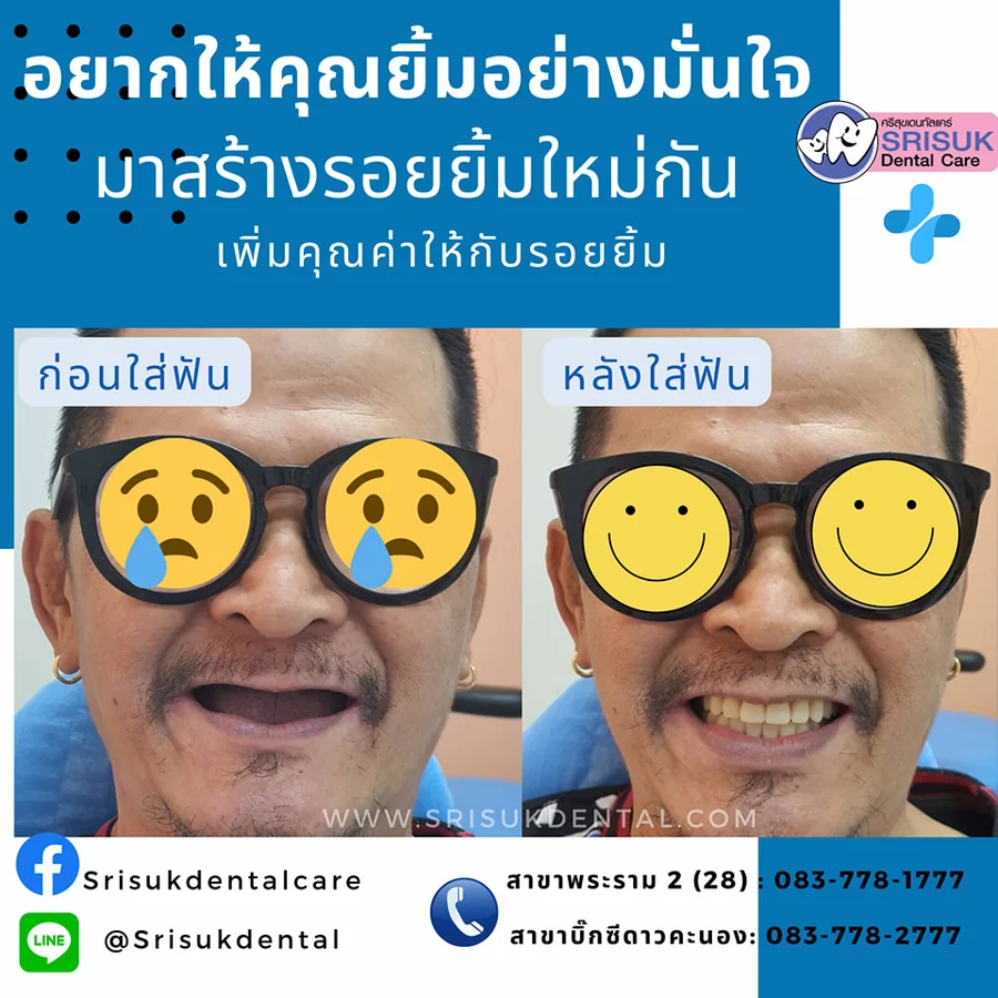 ฟันปลอม 13