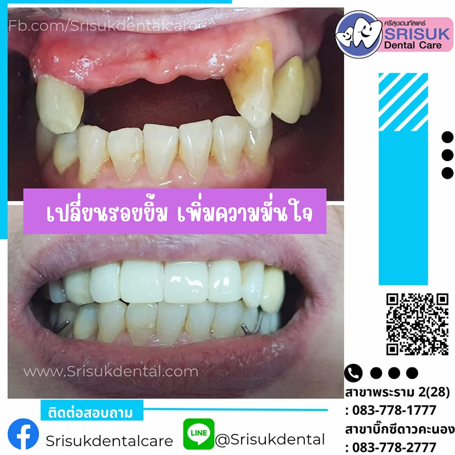 ฟันปลอม 14
