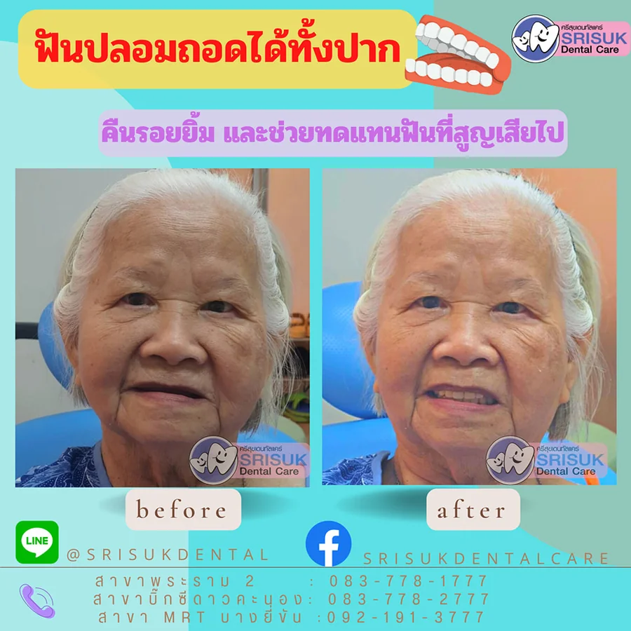 ฟันปลอม 16