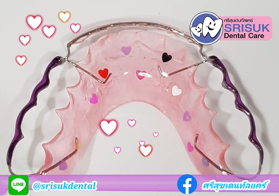 รีเทนเนอร์ 4