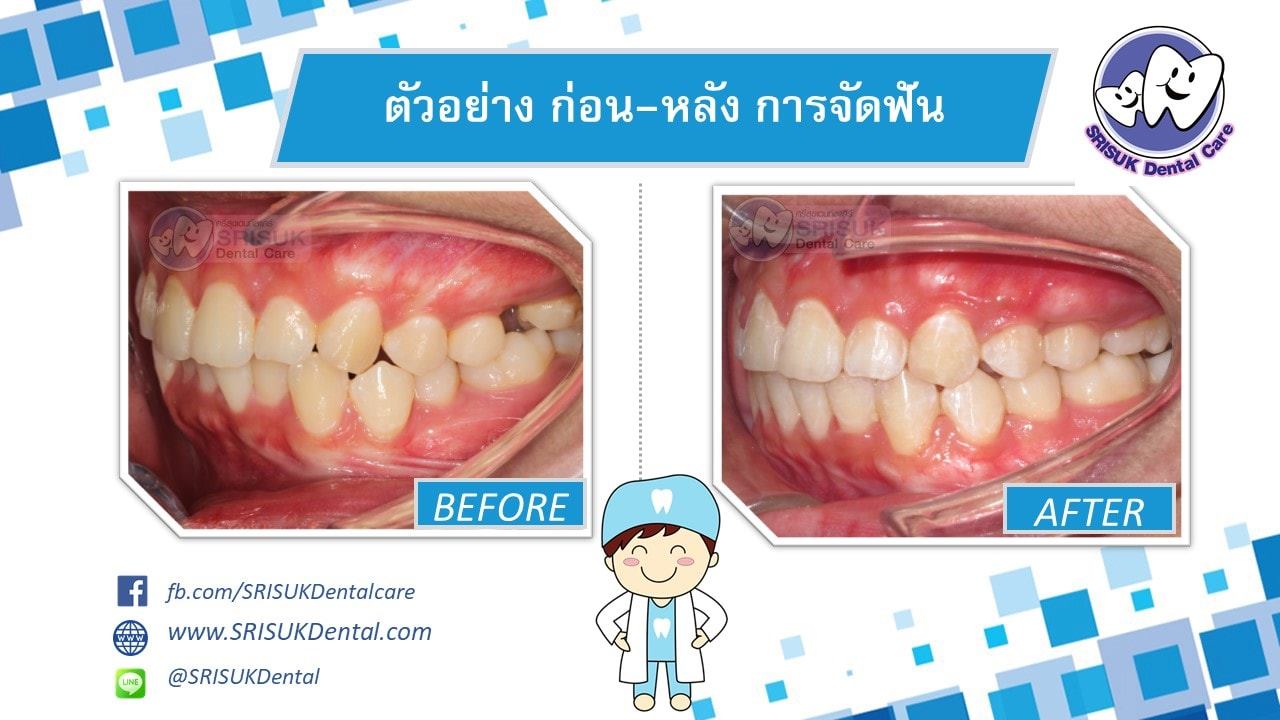 เคสจัดฟัน 1