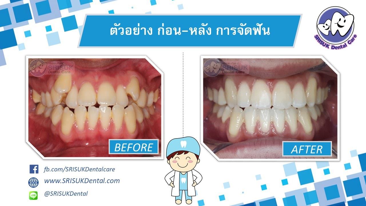 เคสจัดฟัน 2