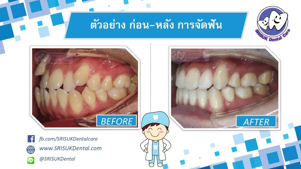 เคสจัดฟัน 3