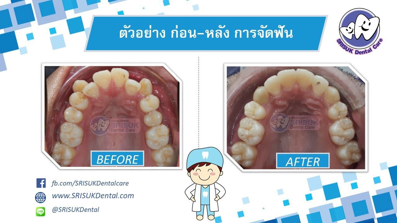 เคสจัดฟัน 4