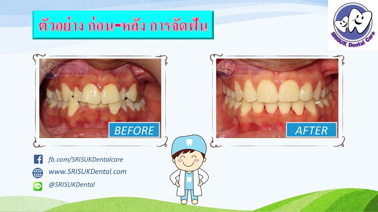 เคสจัดฟัน 5