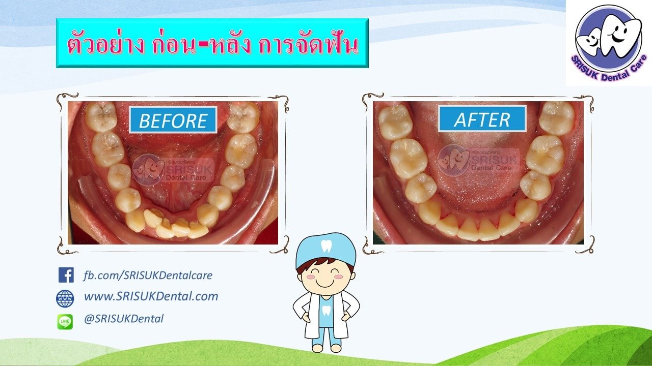 เคสจัดฟัน 6