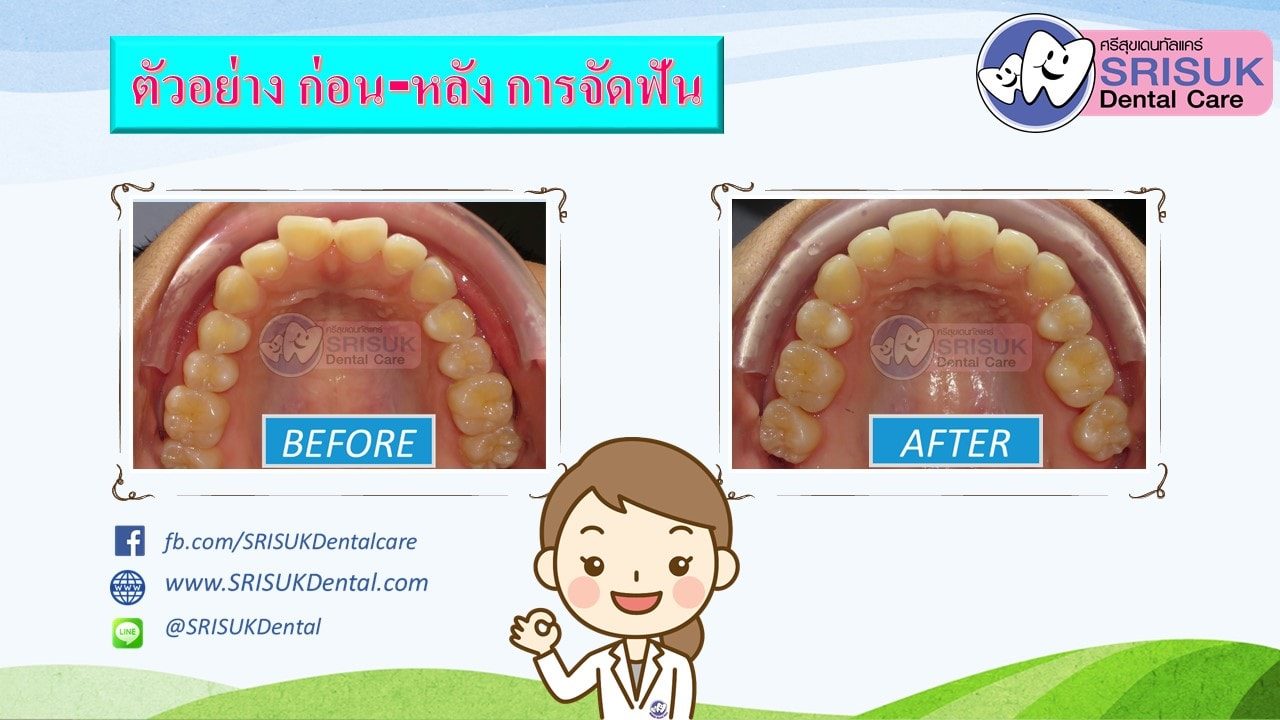 เคสจัดฟัน 7