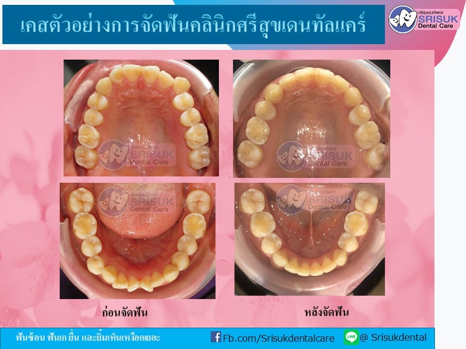 เคสจัดฟัน 8