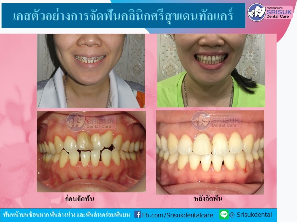 เคสจัดฟัน 9