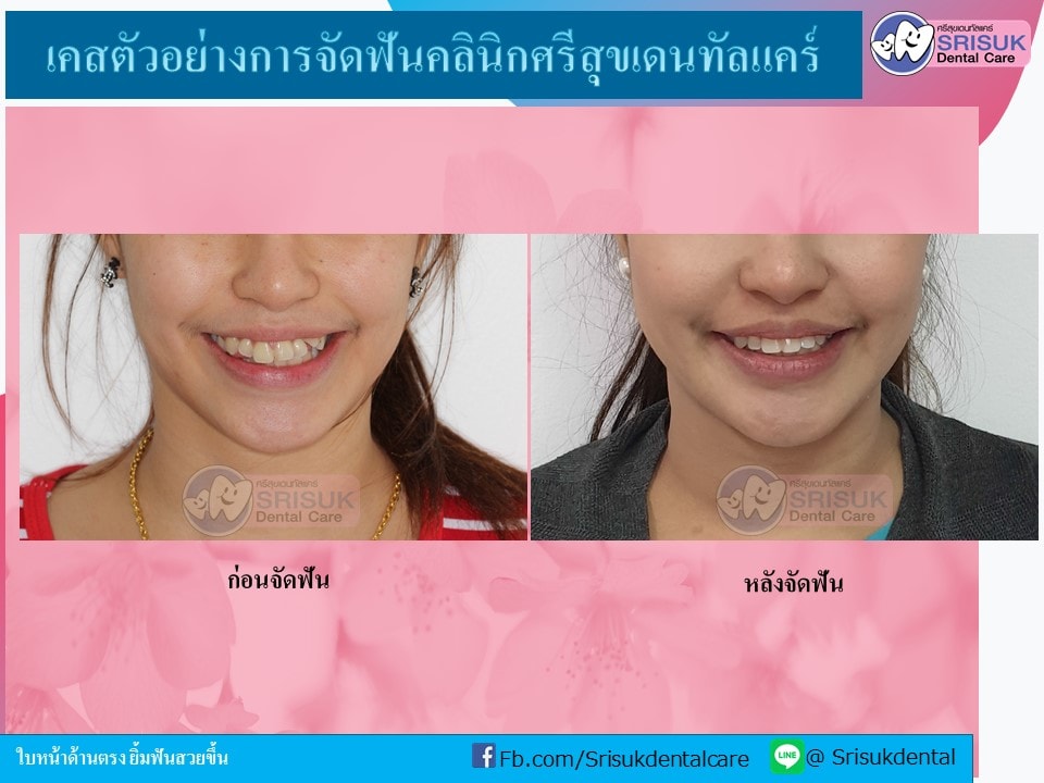 เคสจัดฟัน 10