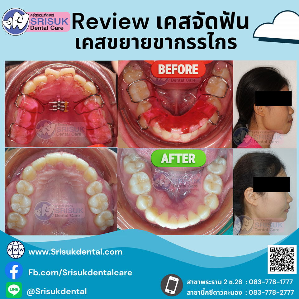 เคสจัดฟัน 11