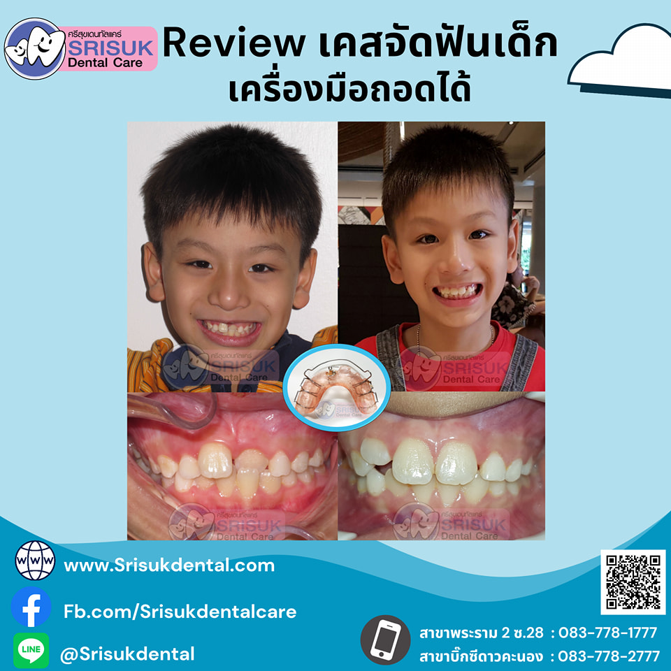 เคสจัดฟัน 12