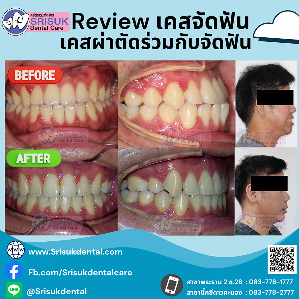 เคสจัดฟัน 13