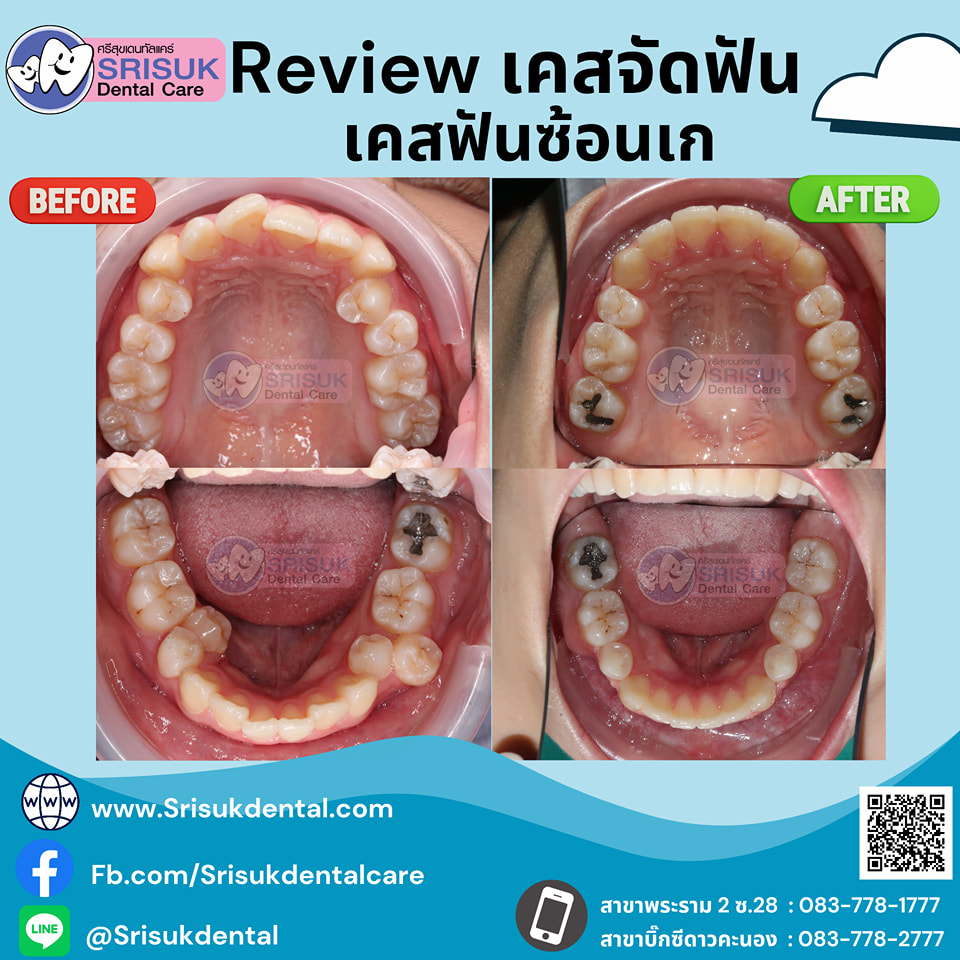 เคสจัดฟัน 14