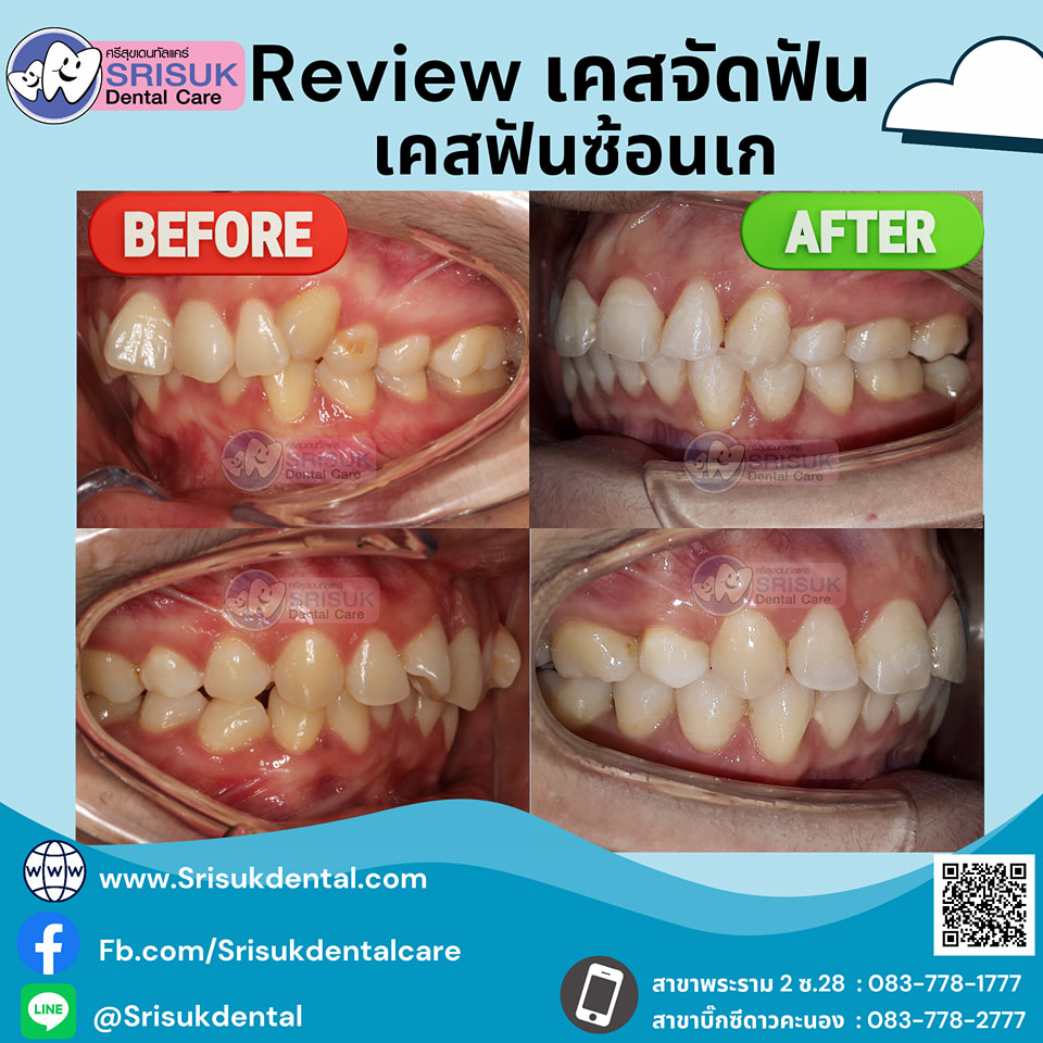 เคสจัดฟัน 15