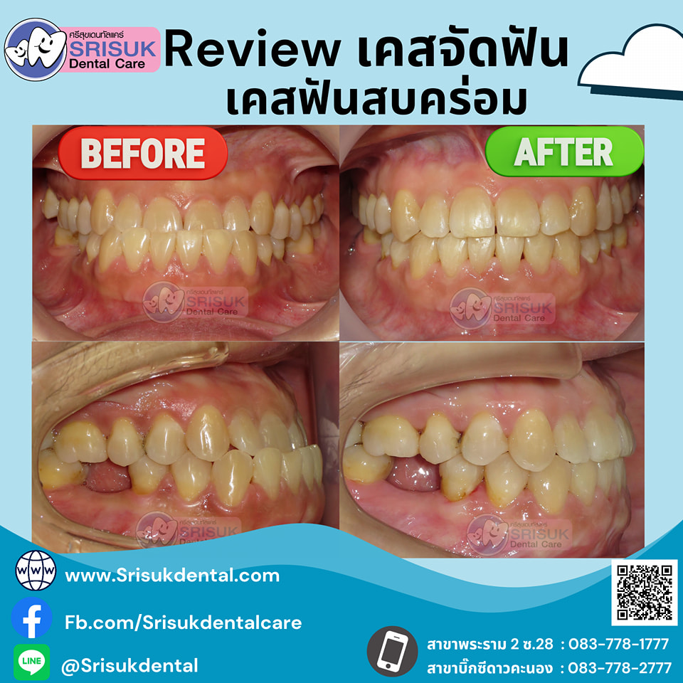 เคสจัดฟัน 16