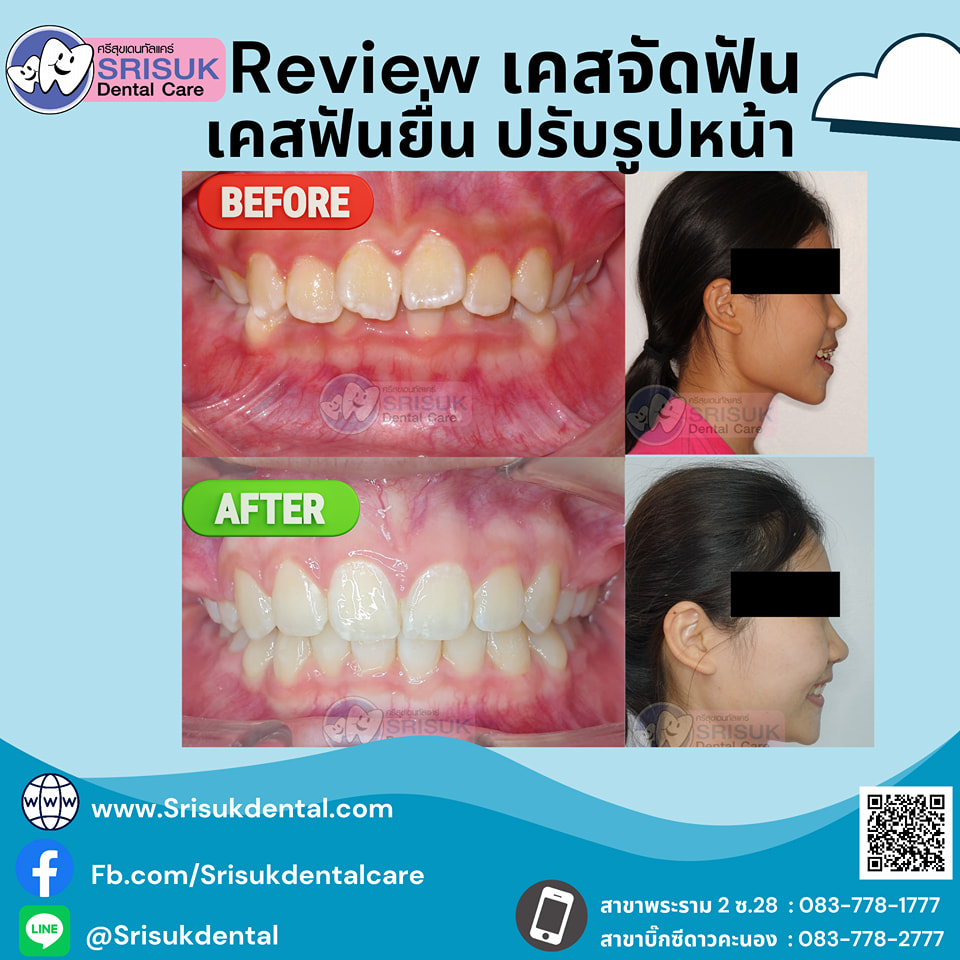 เคสจัดฟัน 17