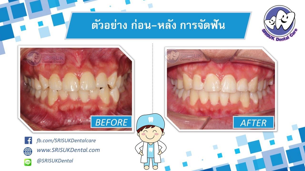 เคสจัดฟัน 18